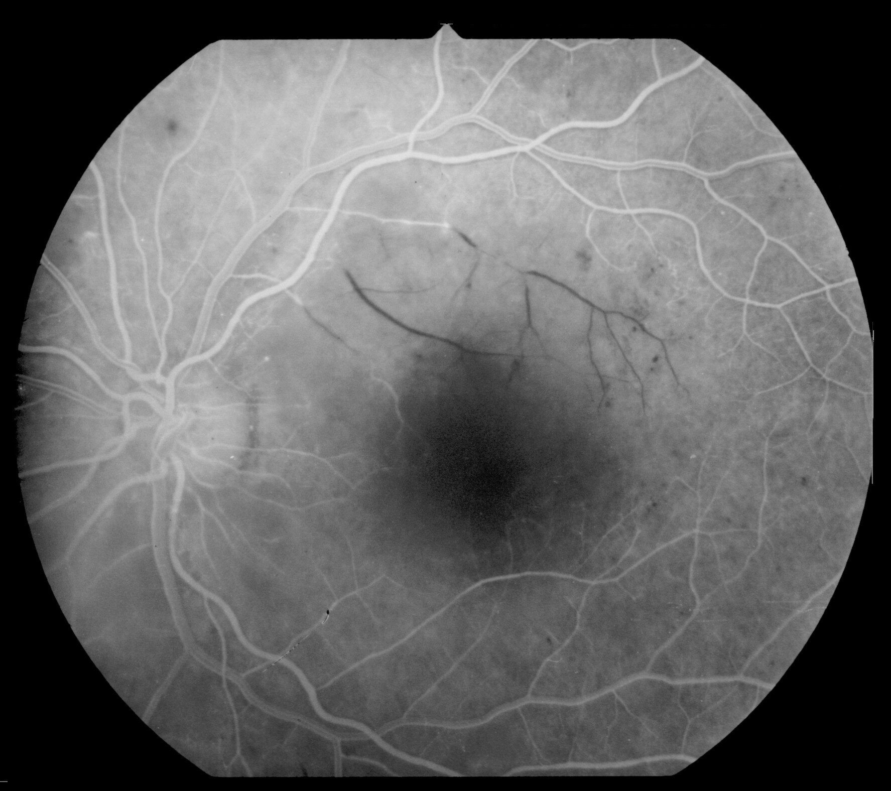 Fluorescein angiogram showing a branch retinal artery occlusion